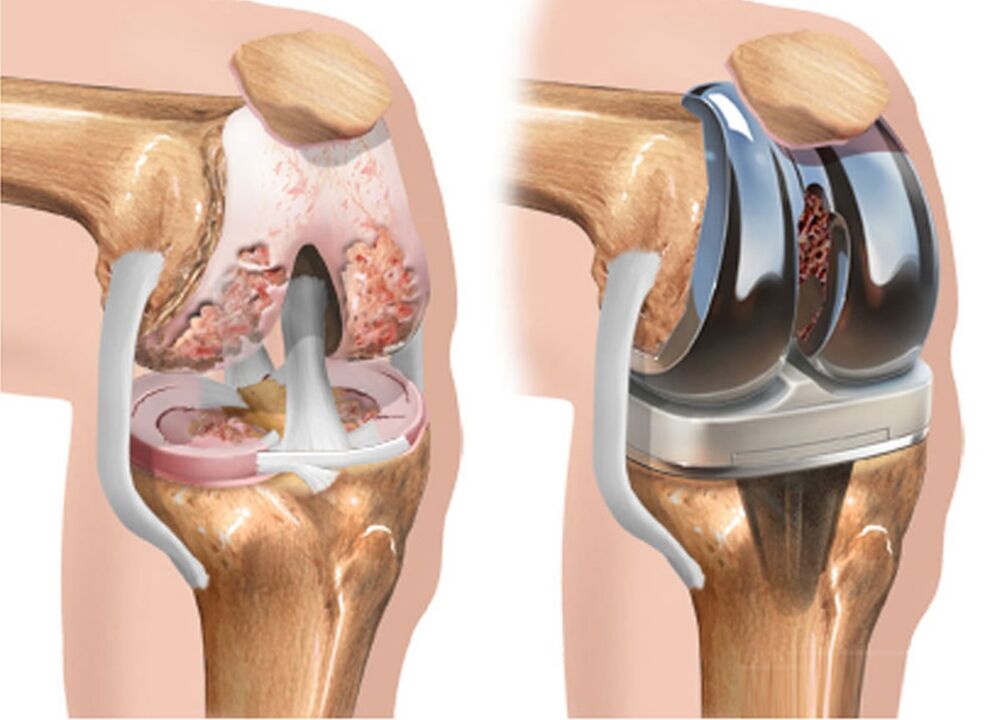przed i po artrozie stawu kolanowego na artrozę