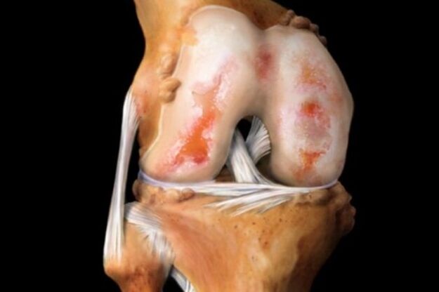uszkodzenie chrząstki w artrozie stawu kolanowego