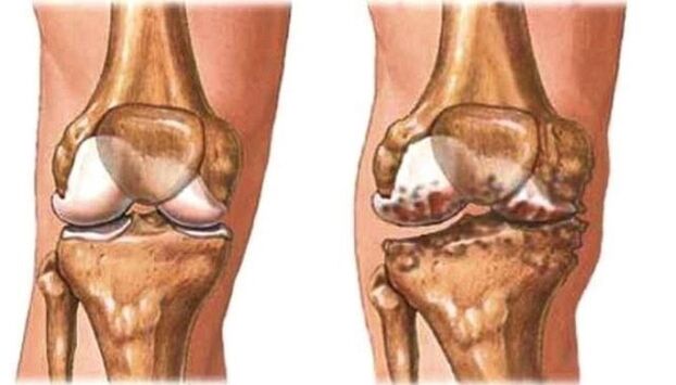 zdrowe kolano i artroza kolana