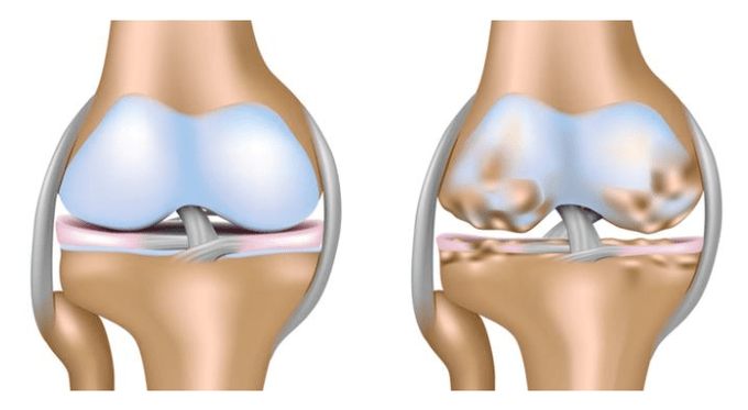 zdrowa chrząstka i uszkodzenie stawu kolanowego z artrozą