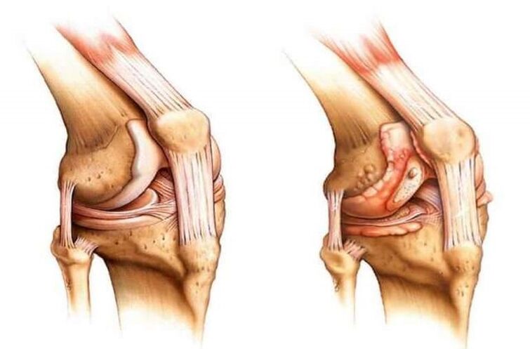 zdrowe kolano i artroza stawu kolanowego