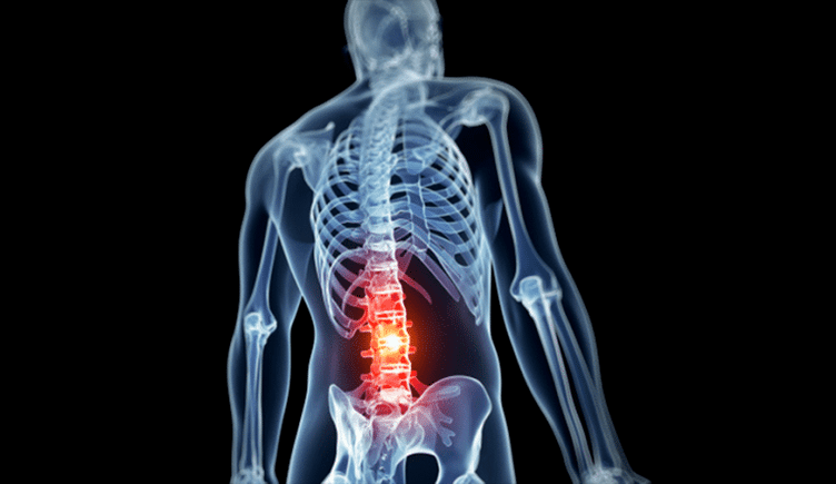 uszkodzenie kręgosłupa lędźwiowego w osteochondrozie