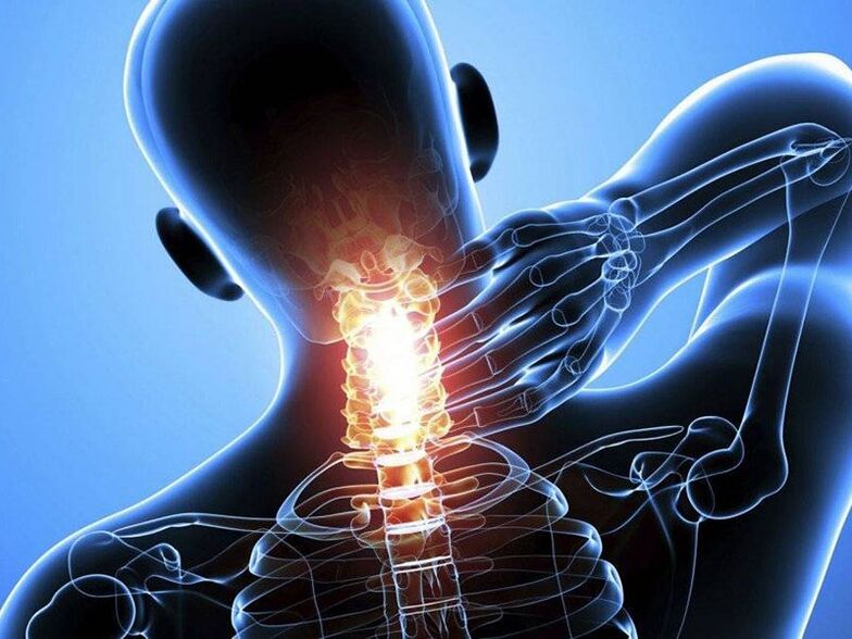 Osteochondrozie odcinka szyjnego kręgosłupa towarzyszy ból szyi