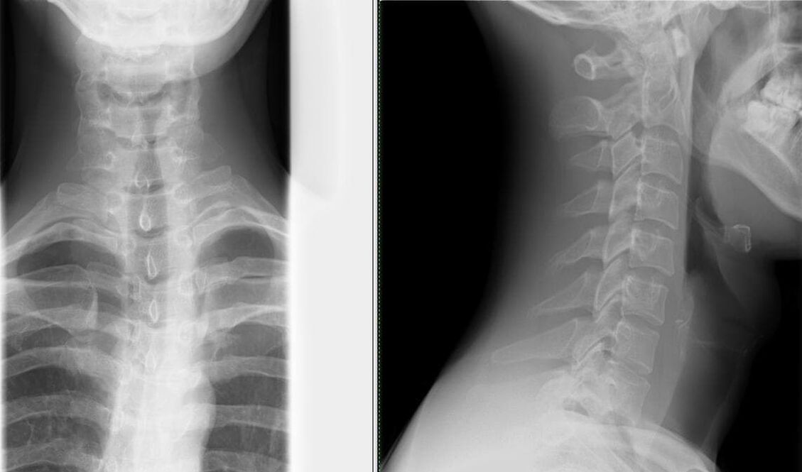 Prostą i skuteczną metodą diagnozowania osteochondrozy jest zdjęcie rentgenowskie kręgosłupa