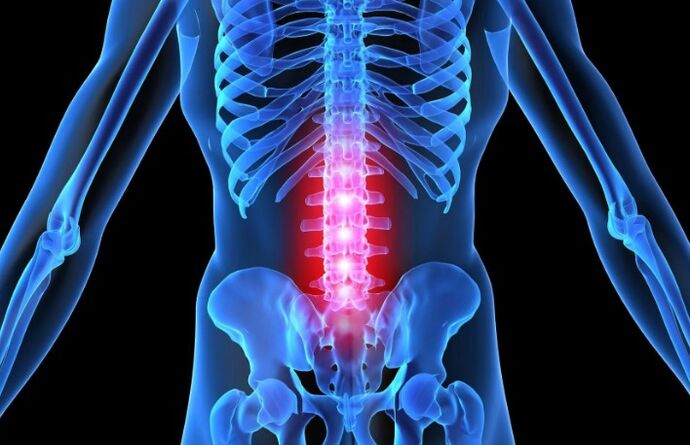 Osteochondroza obszaru lędźwiowego