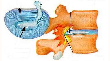 Cechy rozwoju osteochondrozy szyjnej