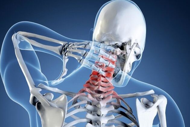 osteochondroza odcinka szyjnego kręgosłupa
